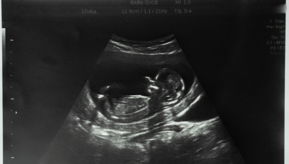 abortion