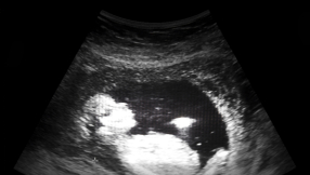 Poll finds majority support legal protection for unborn babies with heartbeat