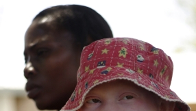 Tanzania bans witch doctors in attempt to stop albino killings
