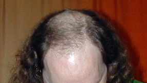 Hair loss cure and remedy? Antidote on the way soon?