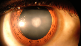 Cataracts treatment: Eye drops for cataracts? Surgery could be a thing of the past treat cataracts?