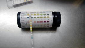 Pancreatic cancer news: Simple urine test shows potential for early detection