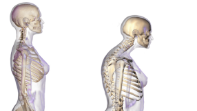 Vitamin D has no clinical benefits to bone health of postmenopausal women, according to study