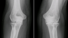 Heart attack risk linked to surgery for osteoarthritis, study finds