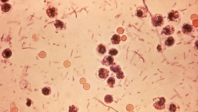 Shigella outbreak: Bay Area counties see an increase in cases