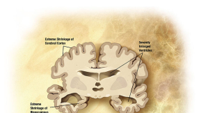 Asthma drug a potential treatment for aging brains, according to new study