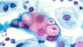 Sexually transmitted diseases spreading in Los Angeles; mobile dating apps blamed