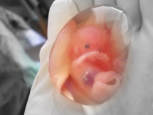 Mother sues doctor over botched abortion that left her unable to have children for life