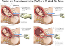 Federal court stops Alabama laws banning child dismemberment, abortion clinics near schools